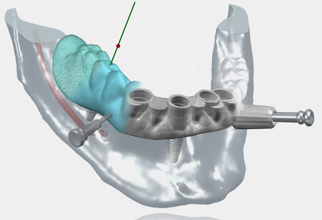 cirugía guiada implantes dentales en Berga